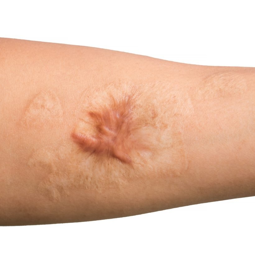 Close up Keloid scar (Hypertrophic Scar) on man arm skin after accident isolated on white background.