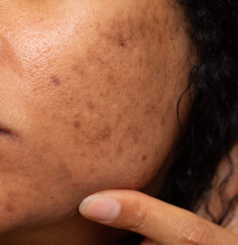 Closeup of Asian woman with dark spots and freckles problems. High quality photo